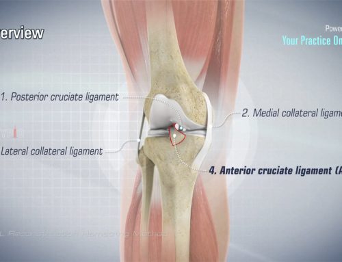 Video über die ACL-Rekonstruktion mit der Hamstring-Methode