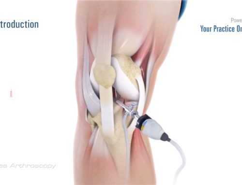 Video über die Kniearthroskopie