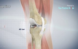 ACL-Rekonstruktion mit Patellasehne