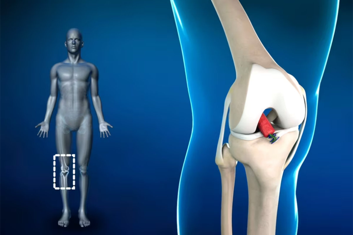 Bridge Enhanced ACL Restoration (BEAR)