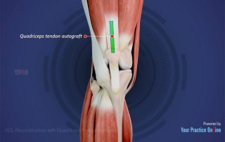 Kreuzbandrekonstruktion mit Quadrizepssehne