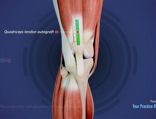 Video über die Kreuzbandrekonstruktion mit der Quadrizepssehne