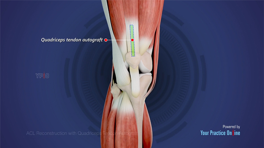 Kreuzbandrekonstruktion-mit-Quadrizepssehne