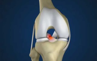 ACL Rekonstruktion Achilles Allotransplantat