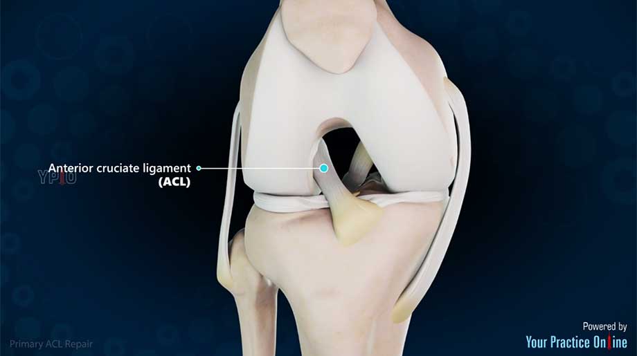 Primäre ACL-Reparatur – Erhalt des vorderen Kreuzbandes