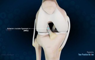 Primäre ACL-Reparatur