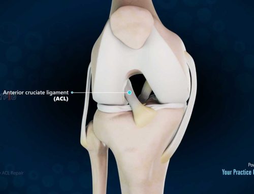 Video über die primäre ACL-Reparatur