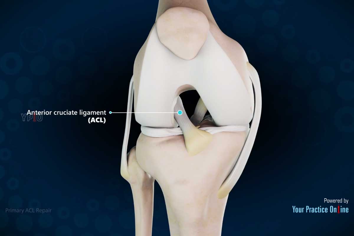 Primäre ACL-Reparatur